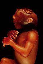 150px-Anencephaly_side