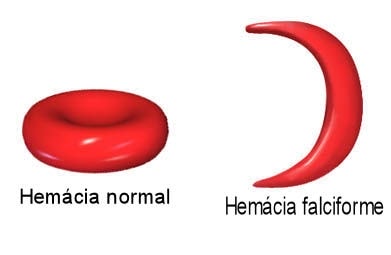 anemia falciforme 3