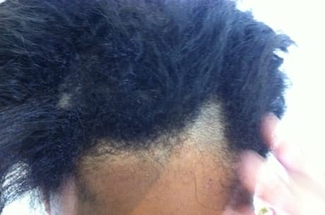 ‘Estou com vergonha de sair de casa’, diz menina que perdeu cabelo após uso de shampoo