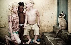 Albinos: Irmãos sem direito a brincadeiras à luz do dia