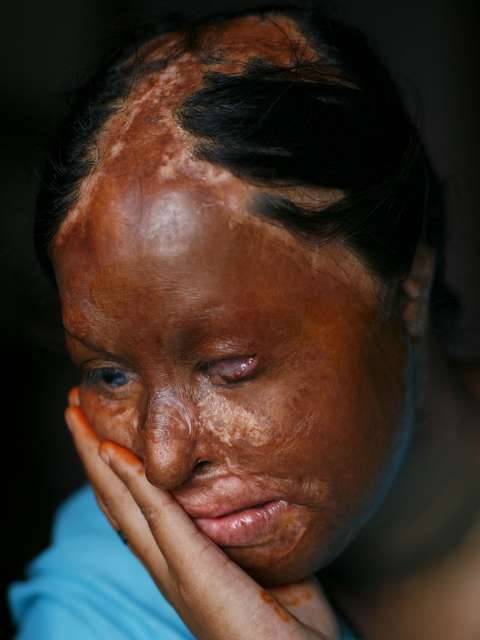 Nalia Raza, 17 anos, foi vítima de violência com ácido em Islamabad, Paquistão em 10 de junho de 2007, tendo de passar por uma cirurgia ocular. Raza foi queimada por ter rejeitado abusos sexuais de seu professor da escola, em uma pequena aldeia no sul do Punjab Foto: Getty Image