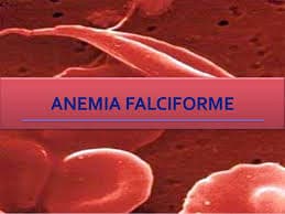 Anemia falciforme atinge o sangue dificulta a oxigenação
