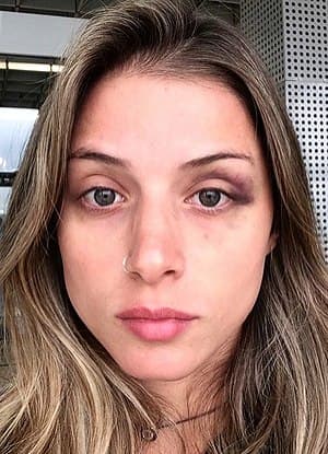 Após ser agredida por ex-BBB, Angela Sousa mostra hematomas e desabafa