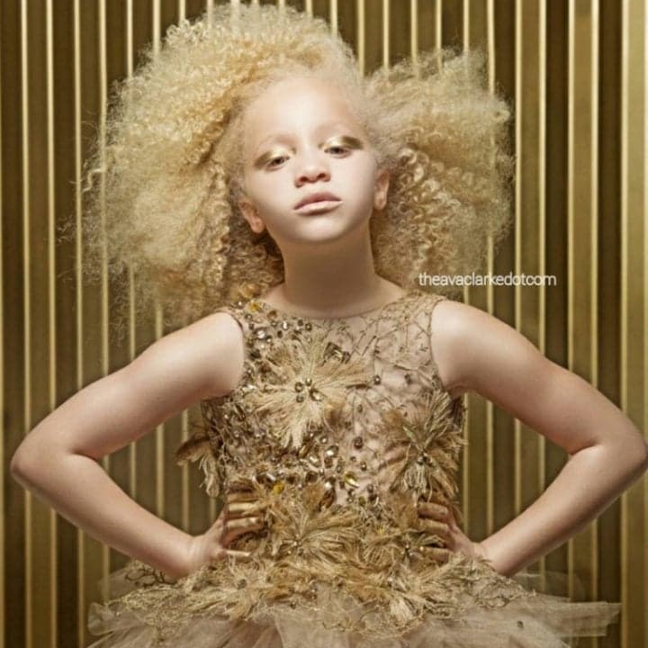 Menina negra com albinismo arrasa no mundo da moda por sua beleza