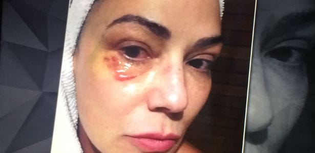 Luiza Brunet sofreu fratura em quatro costelas e afirma ter levado socos e chutes durante o espancamento Imagem: Reprodução/TV Globo