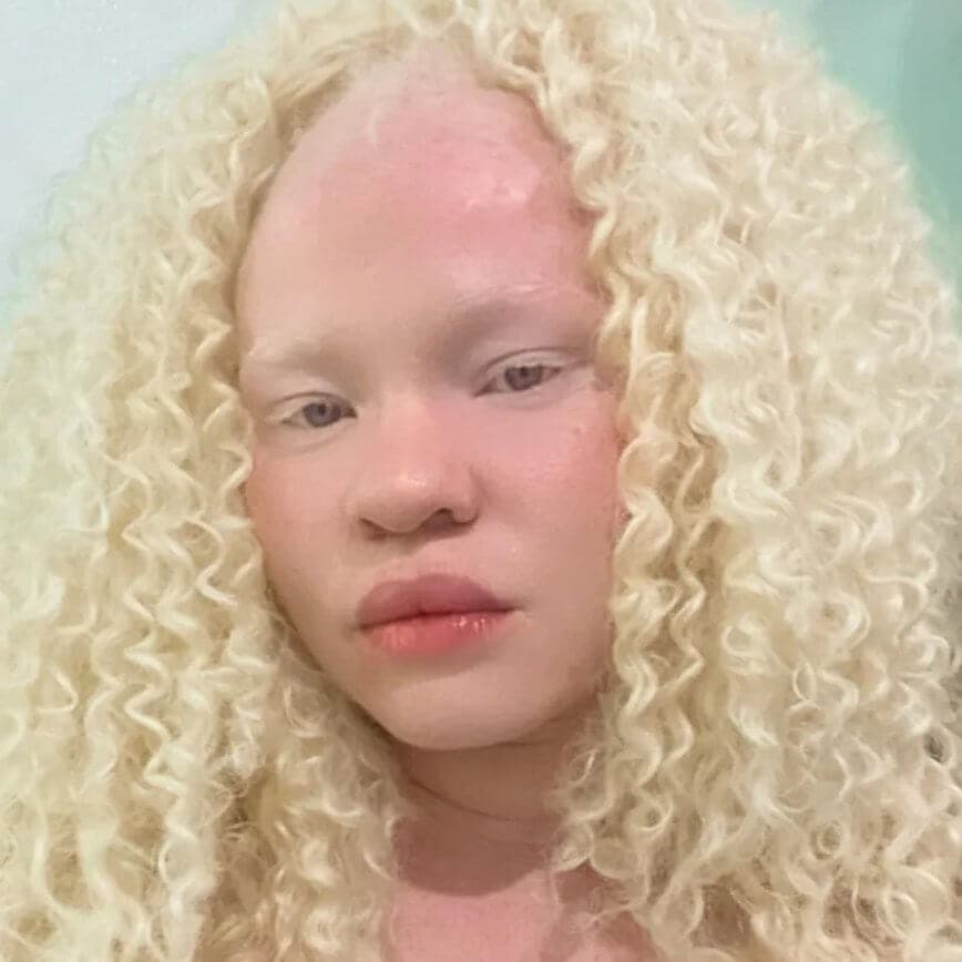 Atriz negra albina fala sobre preconceito: ‘Tratam como doença’
